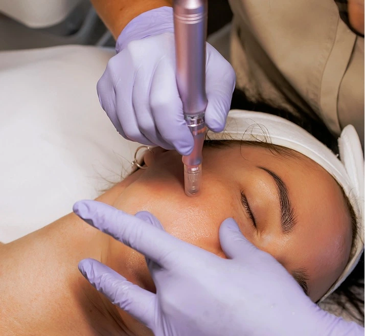 What Is Microneedling in New York City Banner
