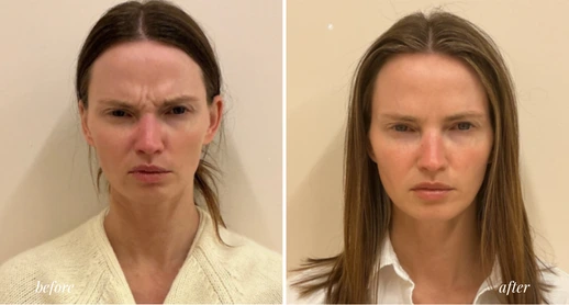 Botox (1)