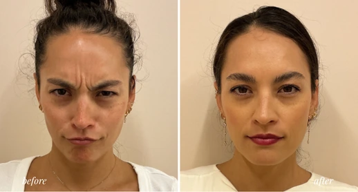 Botox (4)
